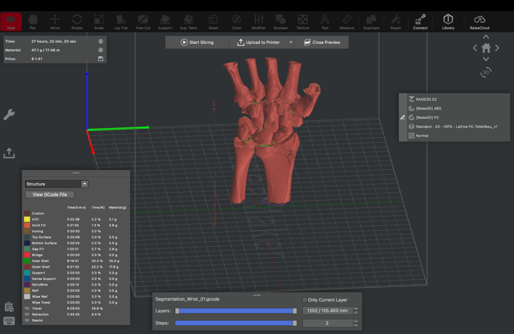 3d printing process for surgical planning