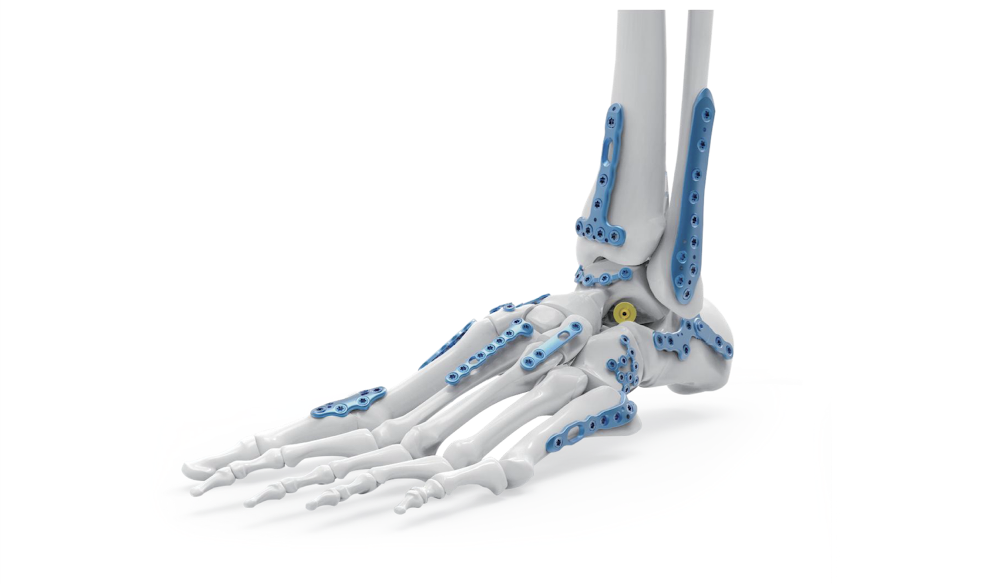 3D printing for surgical planning